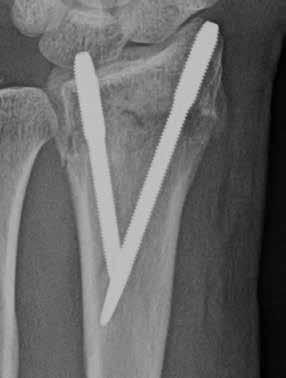 6 7A A single T-Pin is useful for isolated radial styloid fractures.