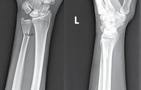 Distal Ulna Fractures Figure 10A. Preoperative PA and lateral radiographs of an unstable ulnar neck fracture with 25 degrees angulation. Negative ulnar variance is noted on the uninjured extremity.