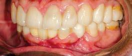 20 Post operative view of occlusal surface of lower teeth showing uniform