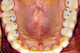 The second case with generalized wear received lithium disilicate crowns