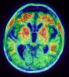 Clinical diagnosis AD=Alzheimer s disease;