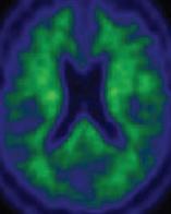 characteristic pattern of spread through the brain We have new