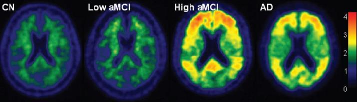 β-amyloid imaging can identify MCI patients with amyloid Cognitively Normal Older person No β-amyloid MCI No