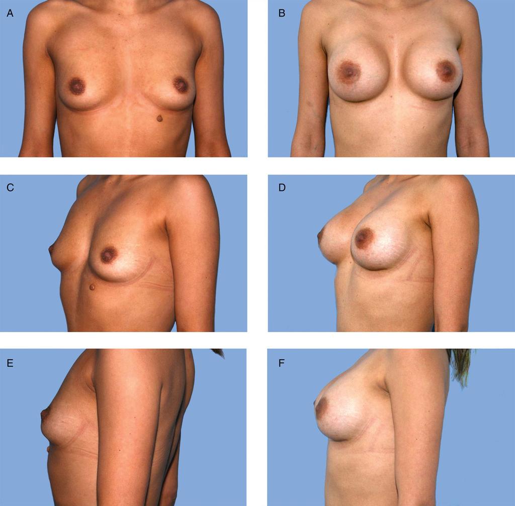276 Aesthetic Surgery Journal 35(3) Figure 2. Round implants in a 30-year-old thin patient give a prominent upper pole convexity. (A, C, E) Preoperative and (B, D, F) 6-month postoperative views.