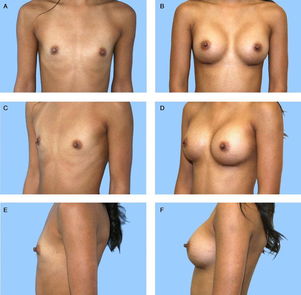 Al-Ajam et al 277 Figure 3. Anatomical implants in a 24-year-old thin patient give a gentler take-off at the upper pole. (A, C, E) Preoperative and (B, D, F) 6-month postoperative views.