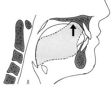 Bolus Figure (6-41): Beginning of swallowing cycle (very light teeth contact). By: Silverman M.