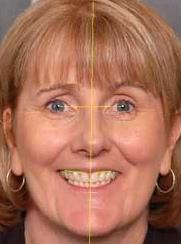 5- Facial measurements Before extraction, the patient is instructed to close the jaws into maximum occlusion, then two tattoo points have been marked, one on the upper half of the face and