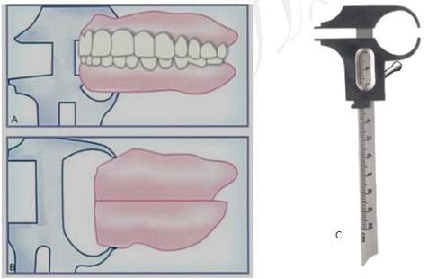 amount of change required. These measurements are made between the ridge crests in the maxillary and mandibular dentures with a Boley gauge.