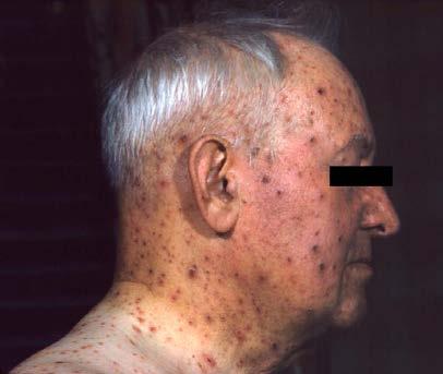 Varicella Primary infection with Varicella-zoster virus (VZV) causes varicella (chicken pox) 1.