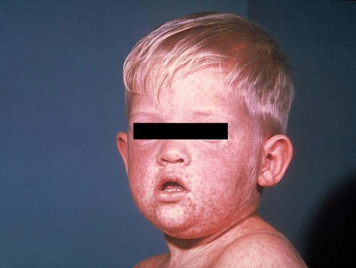 Measles Transmission occurs via respiratory secretions through airborne