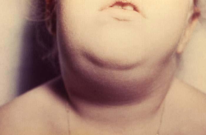 Mumps Transmission occurs via airborne respiratory secretions and by direct contact