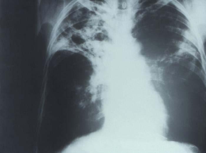 Tuberculosis Tuberculosis (TB) is caused by Mycobacterium tuberculosis complex which are slow