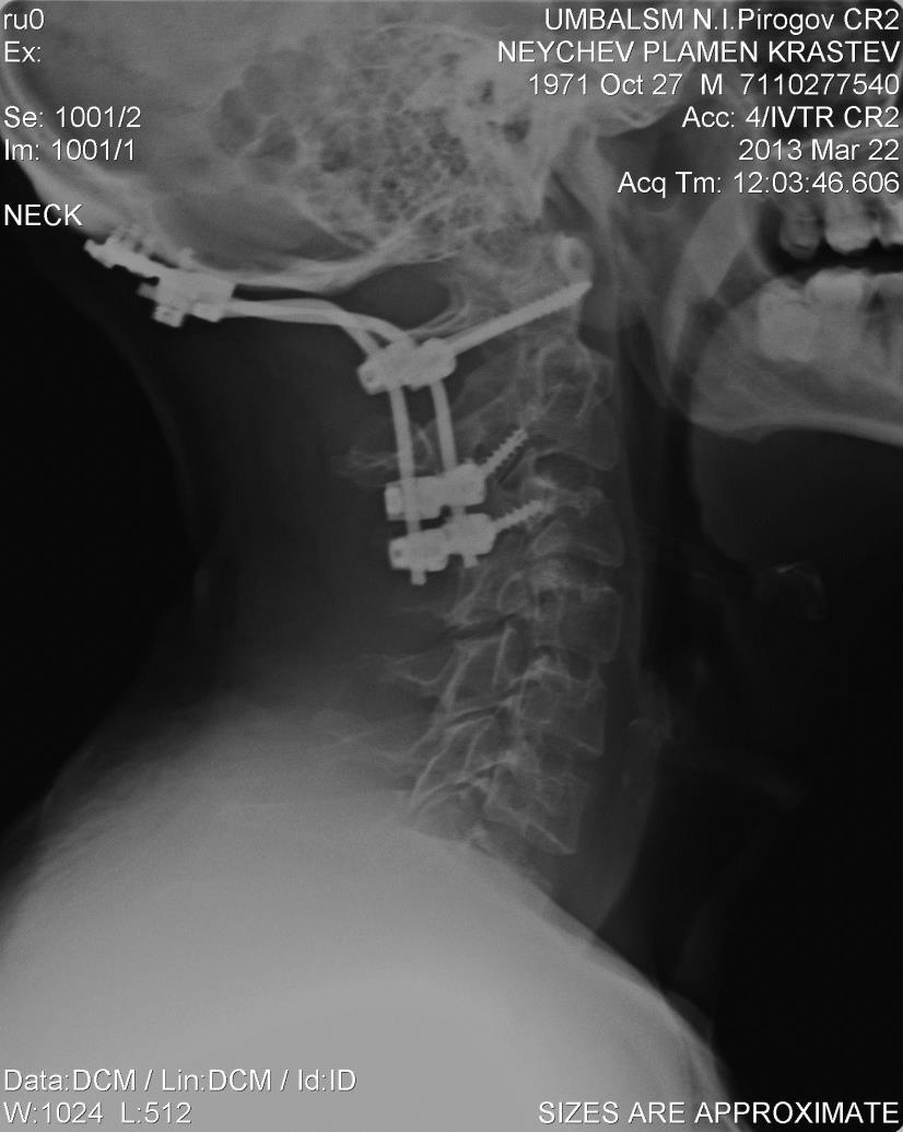 MRATZKOVA G., et al. Figure 3. Cervical roentgenography after occipito spino surgery to C0-C1-C2-C3 Stage 1: rehabilitation activities conducted in an outpatient conditions.
