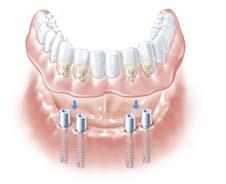 Treatment Implants are definitely something for me too! But will they stay in my jaw? And will it be as simple for me as it was for Heather?