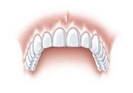 The denture is placed on the tapered crowns and is held securely in place again. The most elegant solution for the edentulous jaw: an implantborne bridge.
