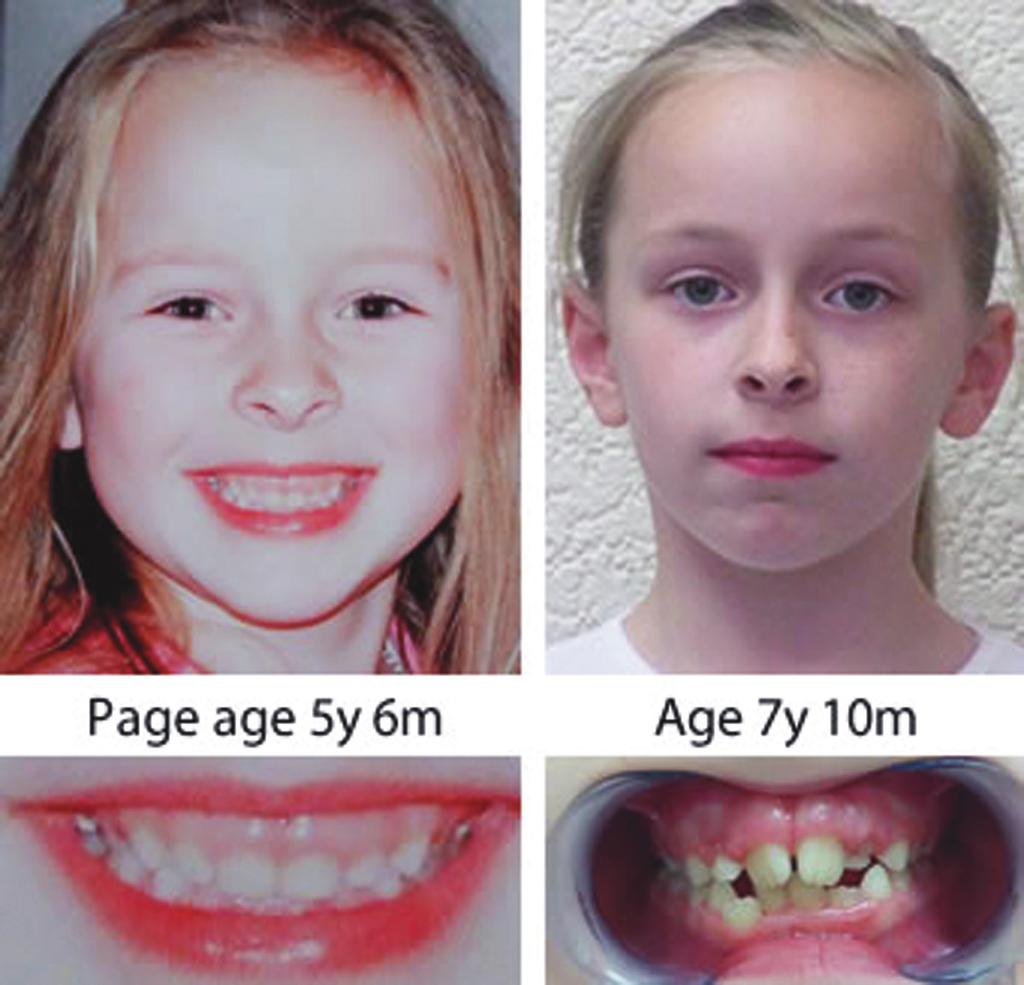 EVERY CHILD HAS THE POTENTIAL TO GROW AN ATTRACTIVE FACE Toddlers and young children generally have welldefined, broad and good-looking faces. However, a different story emerges with many teenagers.
