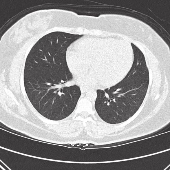 The chest CT showed nonspecific dense bibasilar consolidation (Figure 1(a)). During each hospitalization, she was managed with antibiotics and steroids for presumed pneumonia with asthma exacerbation.