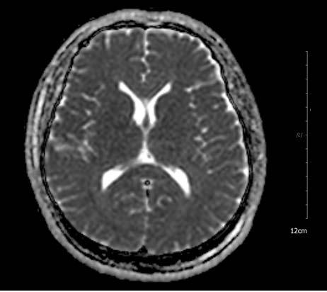 Cerebral Perfusion Recovery on MR Imaging in Post-resuscitated Patient Min Jeong Kim, et al. indicated semi-coma with a Glasgow Coma Scale score of 4.