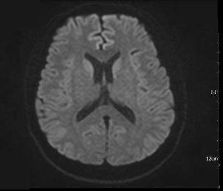 The MRI protocol included conventional fluid-attenuated inversion recovery (FLAIR) imaging, DWI, gradient-echo imaging, perfusion imaging, contrastenhanced cervical MR angiography and intracranial