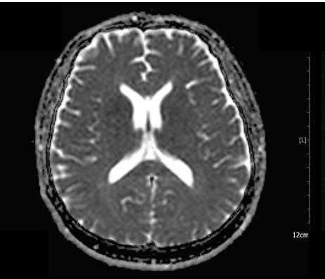 PWI was acquired by dynamic susceptibility contrast MRI with a repitition time (TR)/echo time (TE) of 1790/33 ms, 20 slices, and 0.1 mmol/kg gadolinium-based contrast medium injection at 4 ml/s.