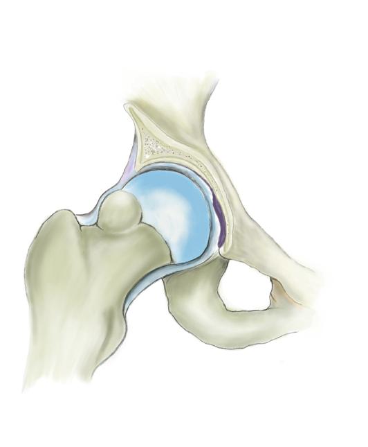 ASSESSMENT SOME COMMON CAUSES OF PAIN AT THE HIP JOINT FEMOROACETABULAR IMPINGEMENT (FAI) There are many variations of the normal hip joint and these often come under the umbrella term of
