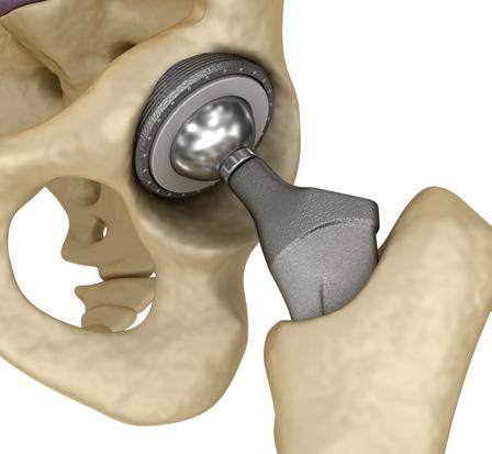 TREATMENT TOTAL HIP REPLACEMENT (THR) When the hip joint is quite worn and other measures have failed to improve pain or restore quality of life, surgery may be considered.