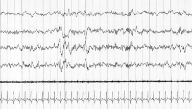 Slow rolling eye movements in the EOG channels Relatively high submental EMG tone Sleep Academic Award 37 Background EEG