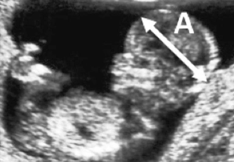 4 Fetal growth is measured during pregnancy to check that the baby is developing as expected. 14 Fig. 4.1 shows one of the measurements that can be made. This measurement is labelled A. Fig. 4.1 (a) (i) Name the measurement shown at A in Fig.