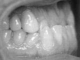 lower incisors, or both. The aim of this clinical report is to describe an example for such a case along with an interdisciplinary treatment alternative.
