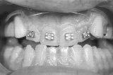 But he accepted readily when orthodontic correction with a treatment time of 6 to 8 months was proposed.