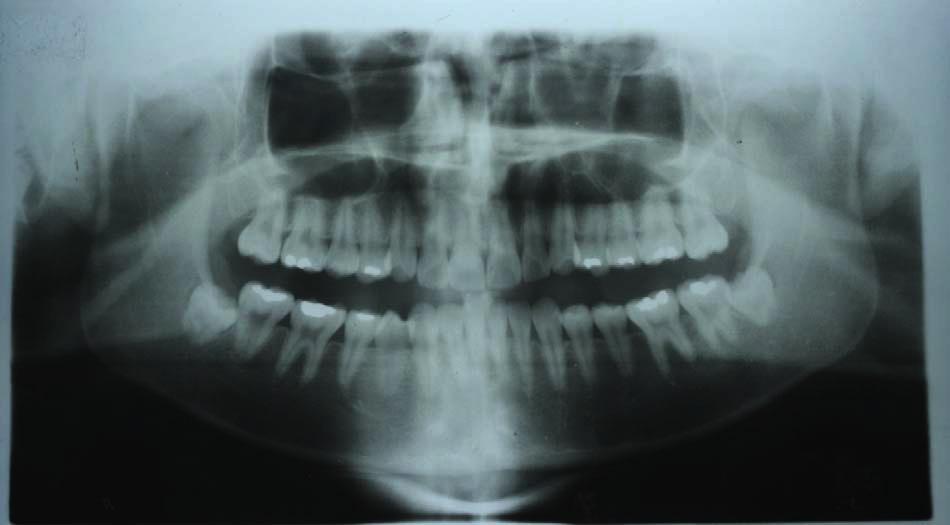 was slightly concave (H-angle, 4 ) and short upper lip (UL-Length, 18 mm) with retrusion of upper and lower lips (Fig. 3A and Table 1).