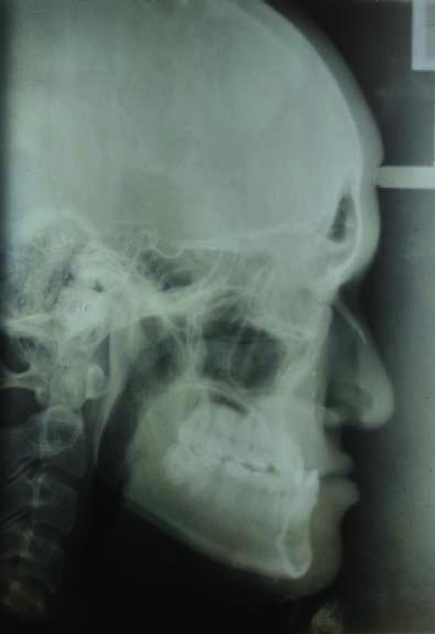 The patient was diagnosed as a severe skeletal Class III deepbite with retrognathic maxilla and prognathic mandible and 5 mm of CO-CR discrepancy.