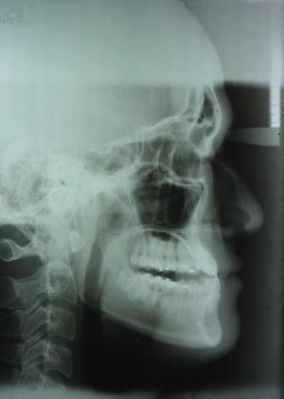 the functional anterior displacement of the mandible.