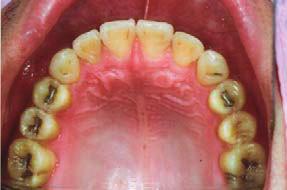 5) show satisfactory dental alignment, Class I canine and molar relationships, well-seated posterior occlusion, overjet