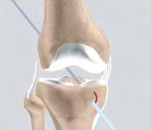 Multi m e dia Health E duc a tion Section: 3/ cont. A stitch is connected from the bone to a guide wire and this is pulled through the predrilled holes in the tibia and femur. (Refer fig.