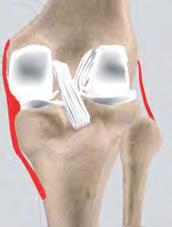 Multi m e dia Health E ducation The PCL prevents the femur from moving too far forward over the tibia. The PCL is the knee's basic stabilizer and is almost twice as strong as the ACL.