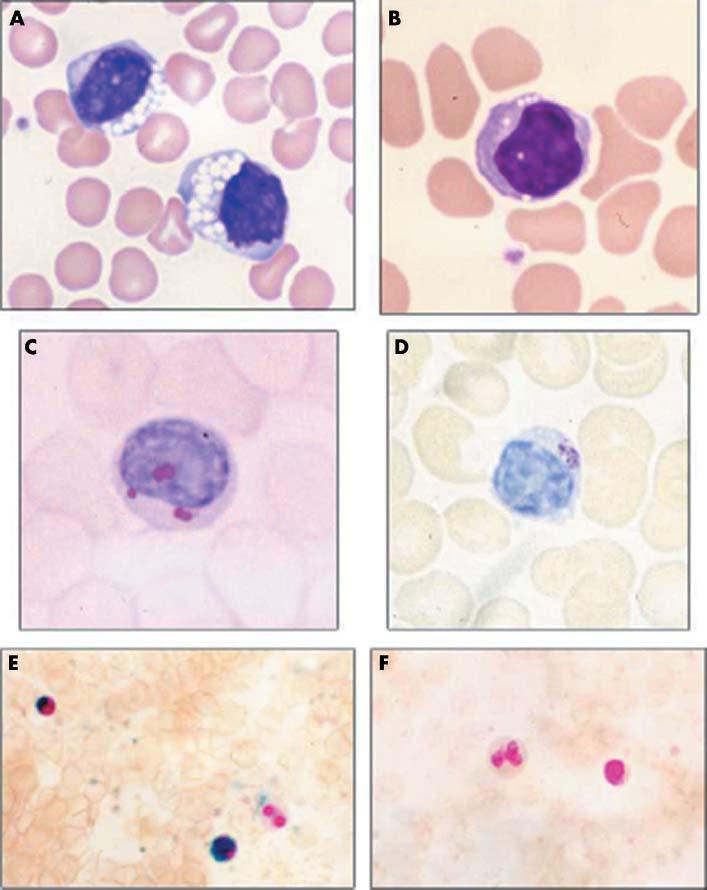 Vacuolated lymphocytes in blood films 1307 investigations may be directed by both the details of the clinical presentation and the characteristics of the lymphocyte vacuolation present (table 3).