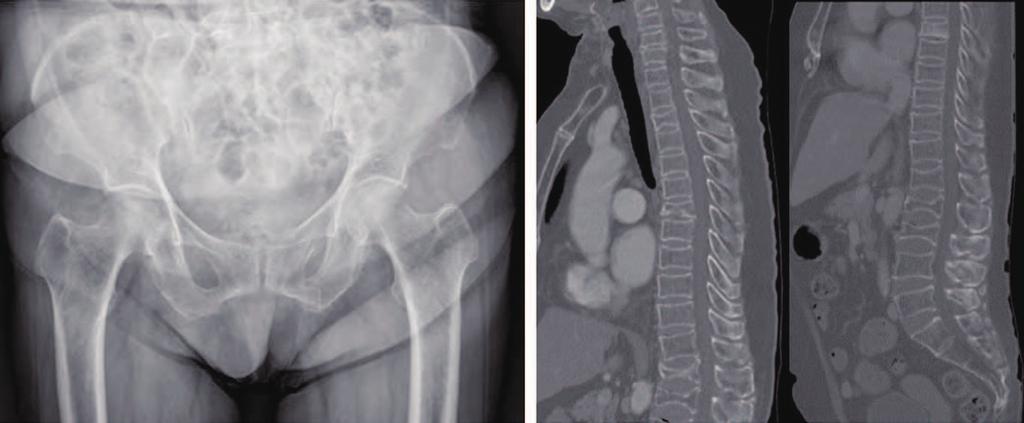 Woong Chae Na et al. Pelvic Insufficiency Fracture in Severe Osteoporosis Patient A B Fig. 1. Radiographs of a 82-year-old female patient.