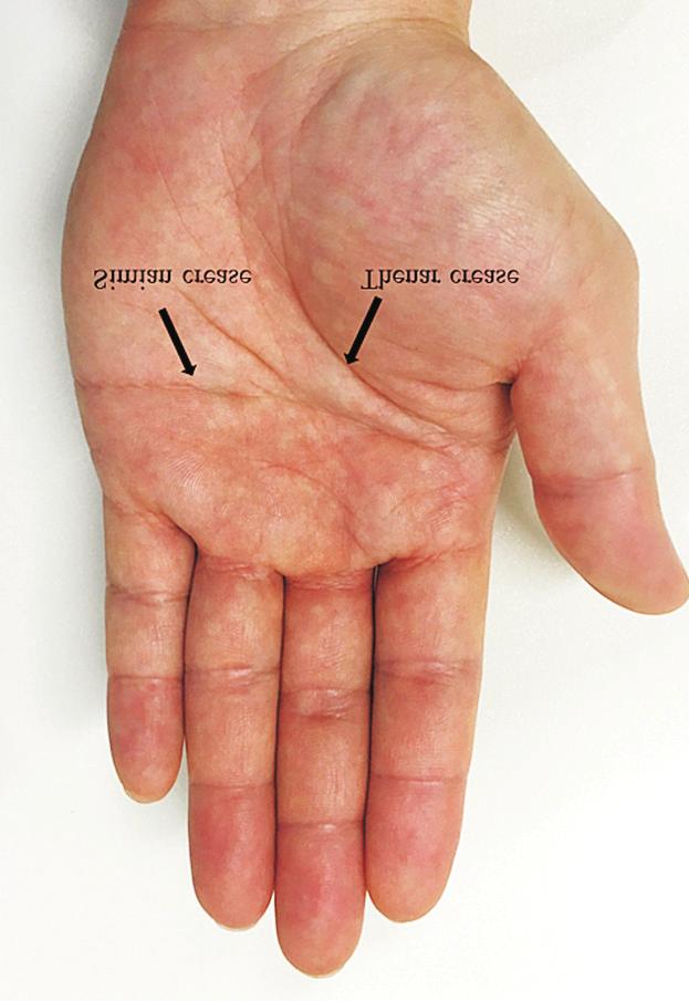 182 A B Fig. 1. The crease of midpalmar region is variable and there are diverse individual palmar crease patterns.