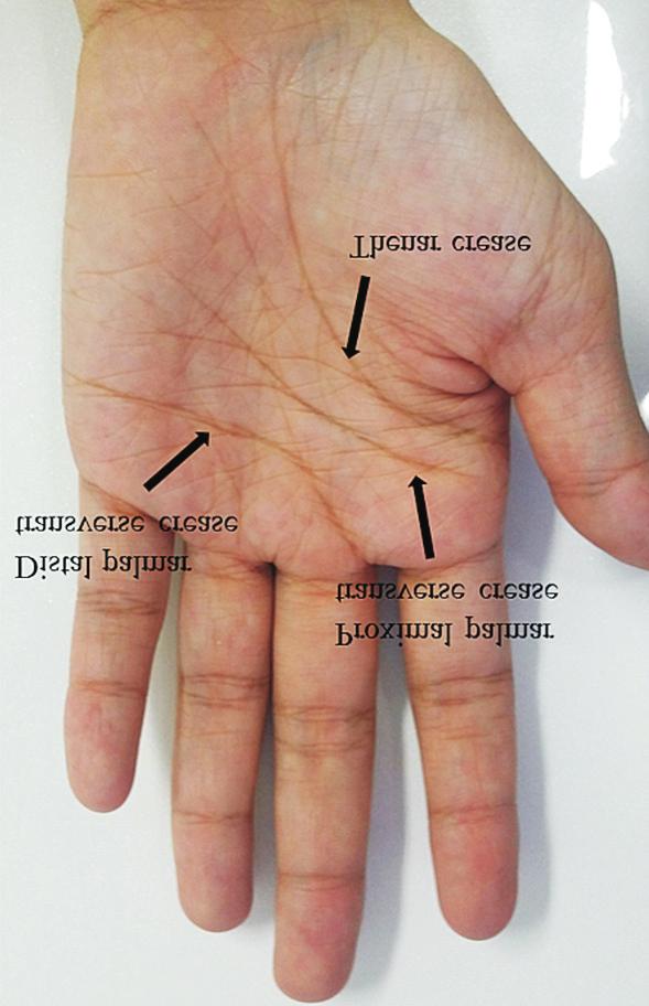 transverse palmar crease that is called a simian crease (B). monly located just proximal to the midpalmar region or proximal to the metacarpophalangeal joint (MCPJ) in order not to limit MCPJ motion.