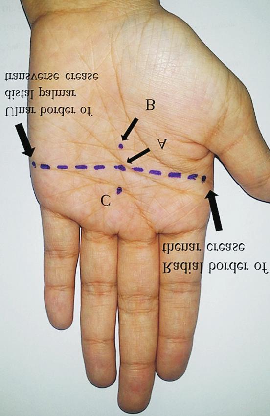 183 were repeated after application of the splint at each of the 3 locations; the subjects were instructed to flex their fingers until there was any resistance during flexion.