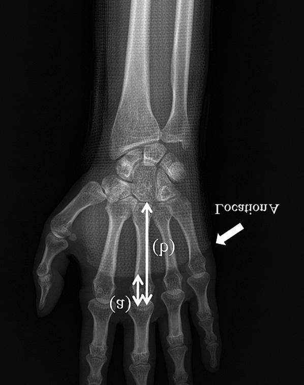 The distance from the metacarpal head to the distal end of the splint was measured for every metacarpal bone of all subjects and the ratio to the whole metacarpal bone length was calculated in