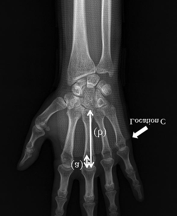 the distal end of the splint to the total metacarpal bone length. The interrater reliability of the measurements was evaluated with use of the intraclass correlation coefficient (ICC).