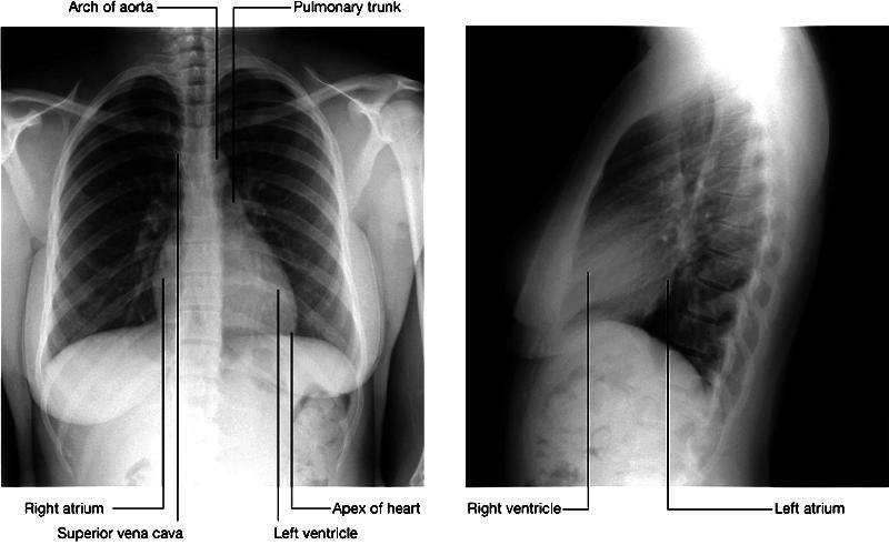 The Chest Radiographs