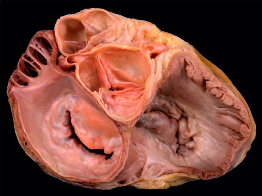 The Cardiac Valves & Their Auscultation mitral valve - anterior cusp - posterior cusp pulmonary valve - anterior cusp - right