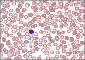 ) Platelets often clumped, giant or aytpical Megakaryocyte fragments Slight to moderate anemia WBC often elevated Repeated low levels of