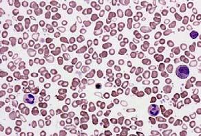 Peripheral Blood Picture Which of the following terms best describes this blood picture? A. Blast crisis B. Pancytosis C.
