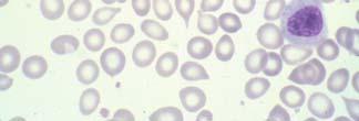 shift PMF - LAB FEATURES Hallmarks Leukoerythroblastic blood picture Dacryocytes (teardrop RBCs) LAP normal to increased JAK2 mutation is found in ~50% of patients Associated with longer