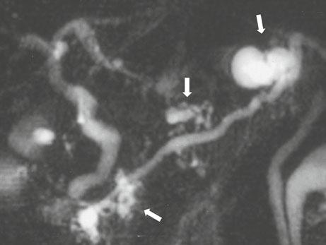 6 M. Tanaka Fig. 1.3 MRCP showing multiple branch duct IPMNs 1.