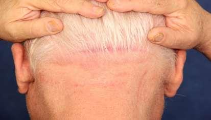 Psoriasis of the scalp а)